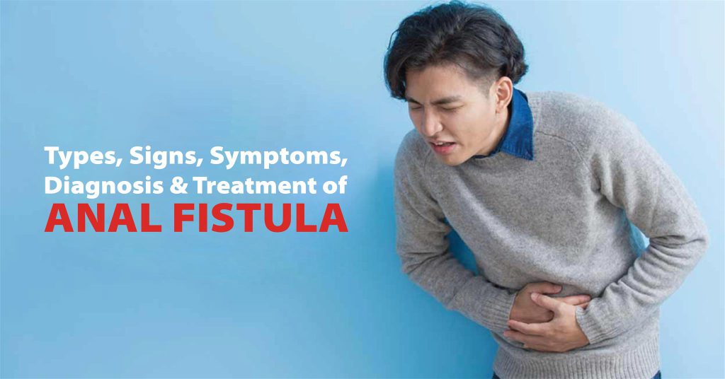 Types, Signs, Symptoms, Diagnosis & Treatment of Anal Fistula