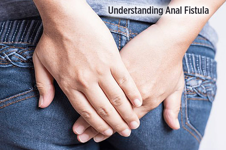 Understanding Anal Fistula