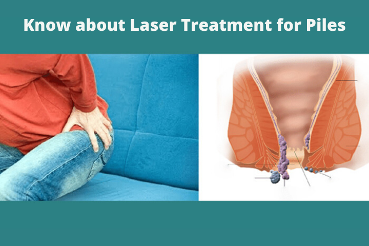 Know about laser treatment for piles