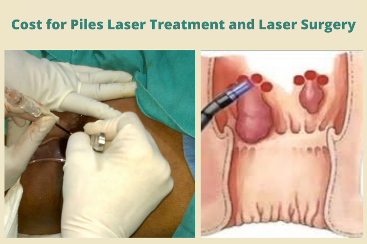 Cost for Piles Laser Treatment and Laser Surgery