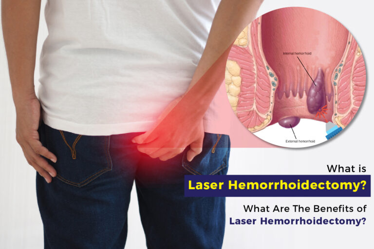 What is Laser Hemorrhoidectomy?
