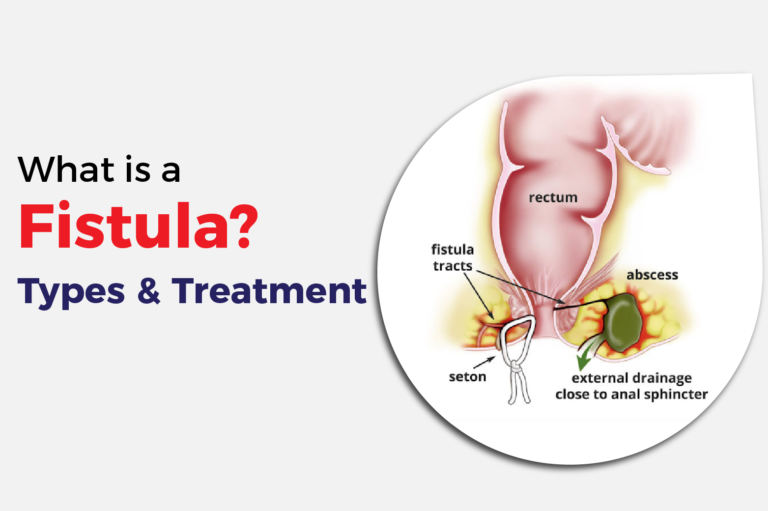 What is a Fistula?