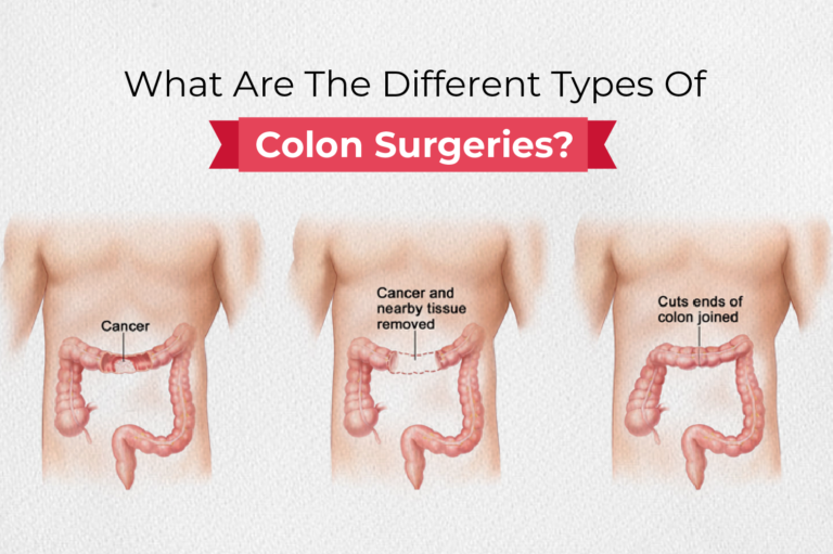 What Are The Different Types Of Colon Surgeries?