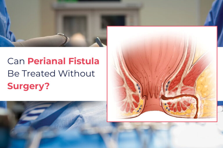 Can perianal fistula be treated without surgery?