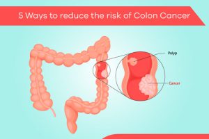 5 Ways How to reduce the risk of Colon Cancer