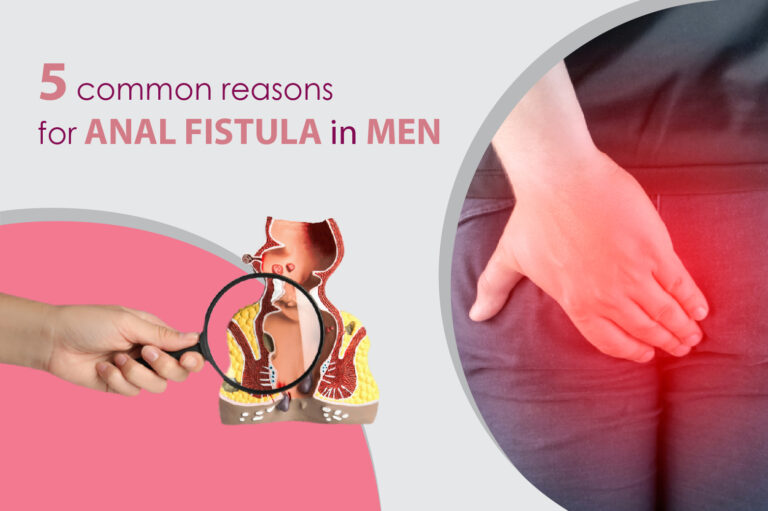 5 common reasons for anal fistula in men