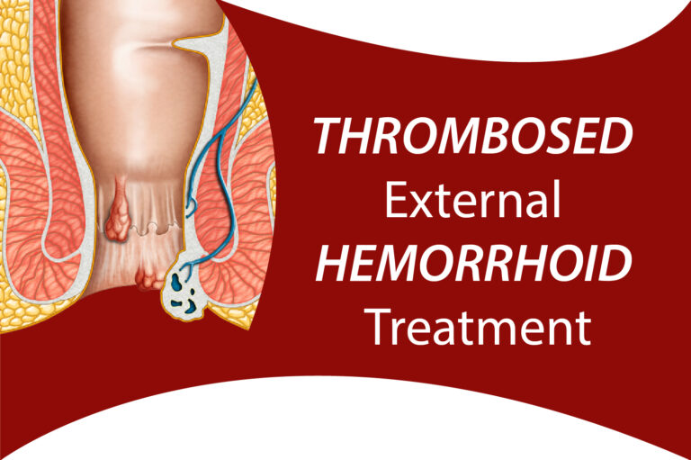 What is Thrombosed External Hemorrhoid Treatment