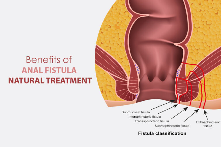 Benefits of Anal Fistula Natural Treatment