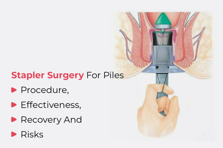 Stapler Surgery for Piles