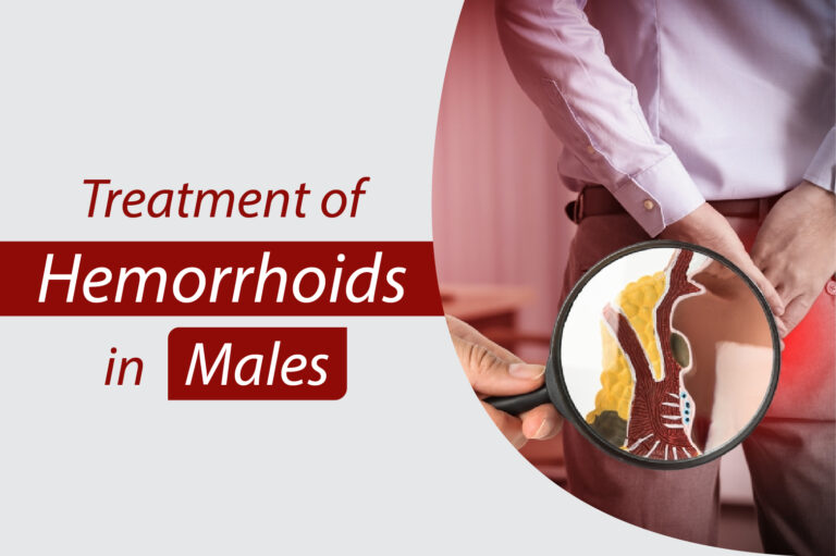 Treatment of Hemorrhoids in Males