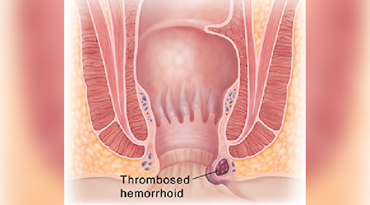 Internall and External Hemorrhoids
