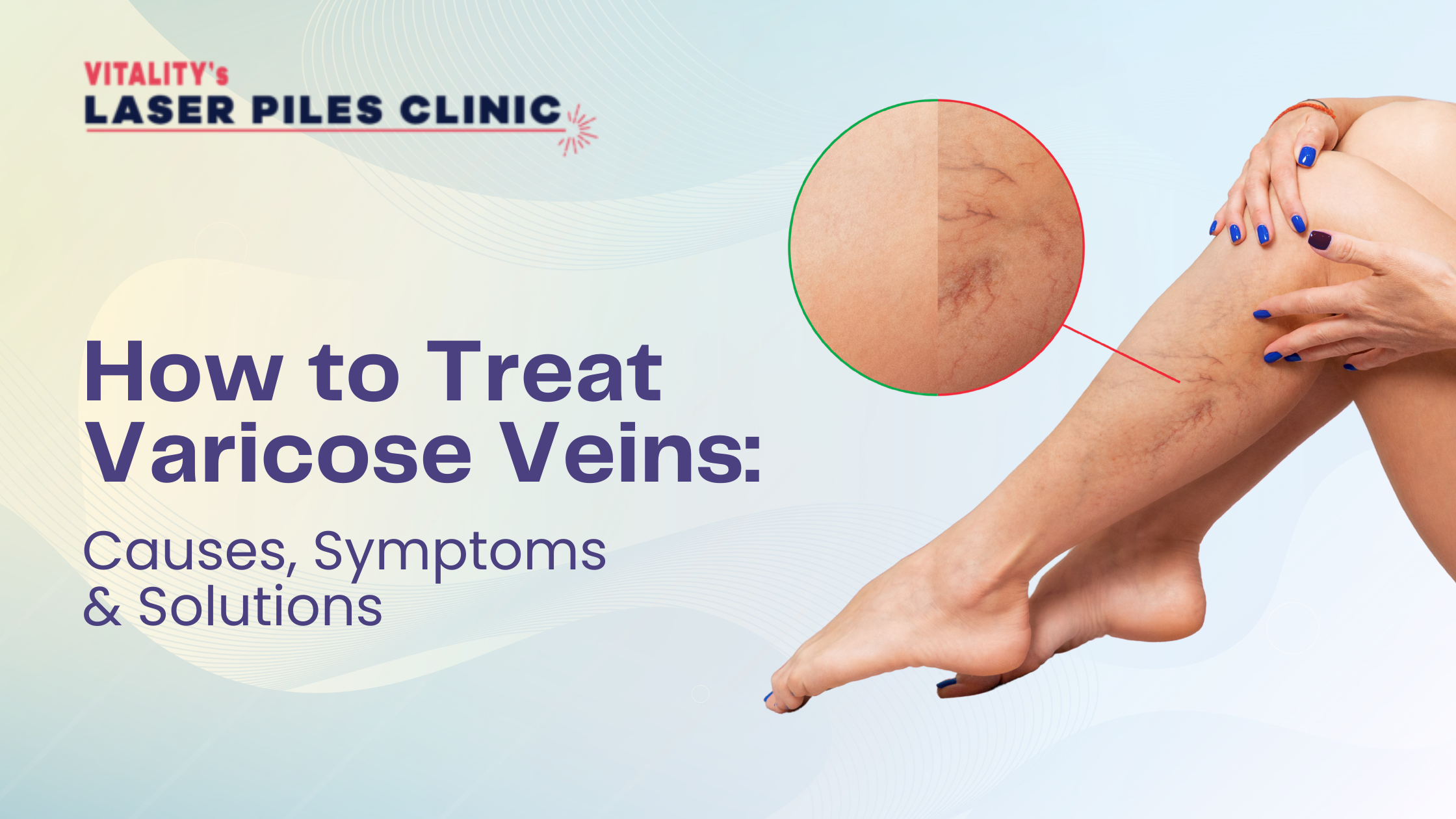 Varicose veins treatment awareness – close-up of leg showing bulging veins with medical illustration, Vitality’s Laser Piles Clinic banner.