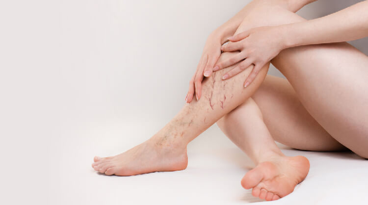 Causes of varicose veins