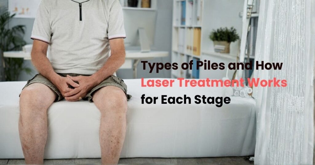 Types of Piles and How Laser Treatment Works for Each Stage