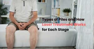 Types of Piles and How Laser Treatment Works for Each Stage