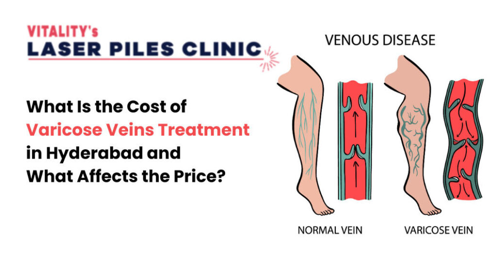 What Is the Cost of Varicose Veins Treatment in Hyderabad and What Affects the Price?